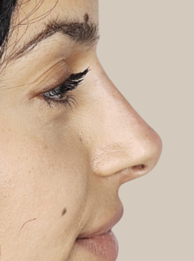 rhinoplasty after 1