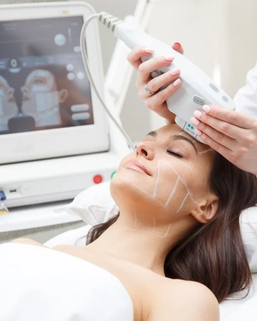 ultherapy stock image female treatment