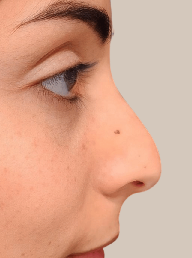 nose filler before from clinic