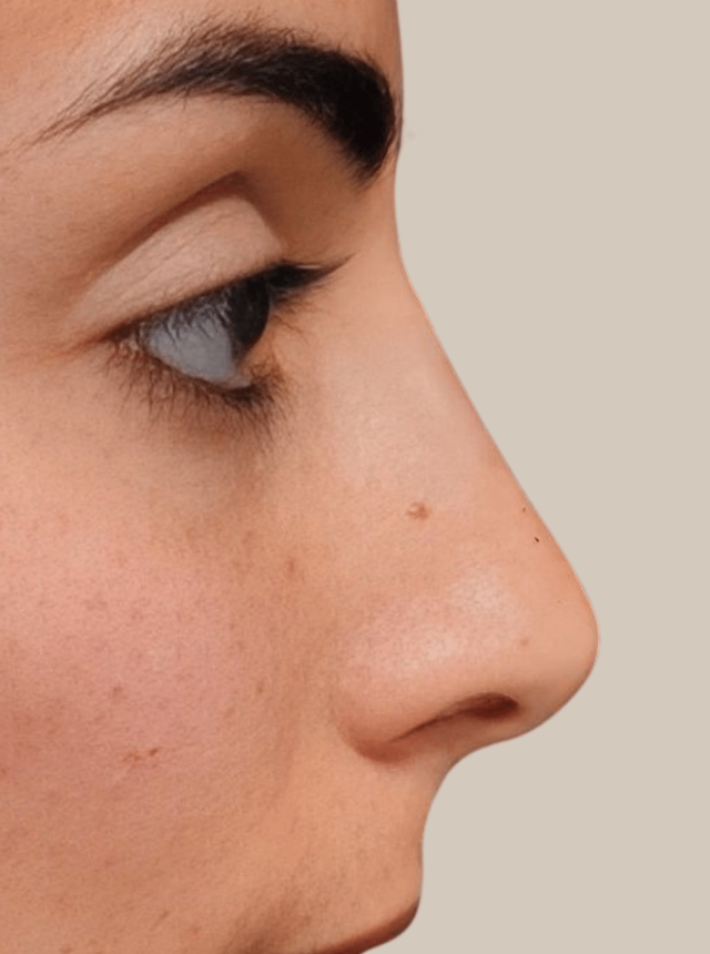 nose filler after from clinic