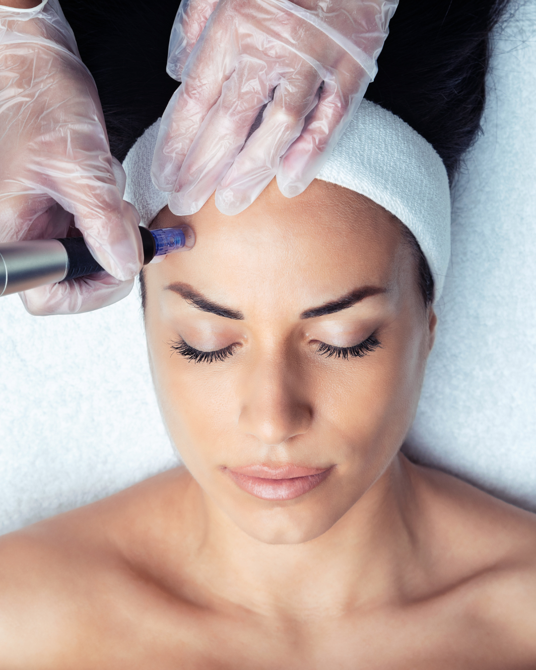 microneedling face treatment