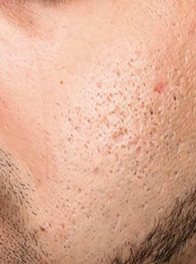 microneedling before