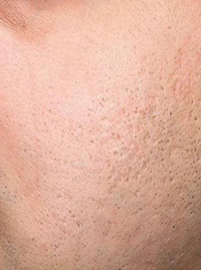 microneedling after