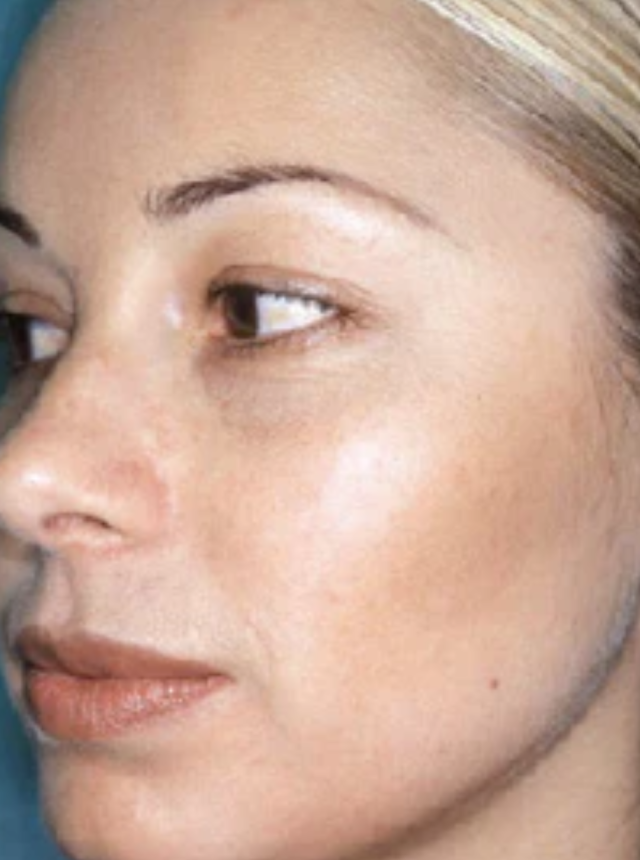 dermaceutic peel after