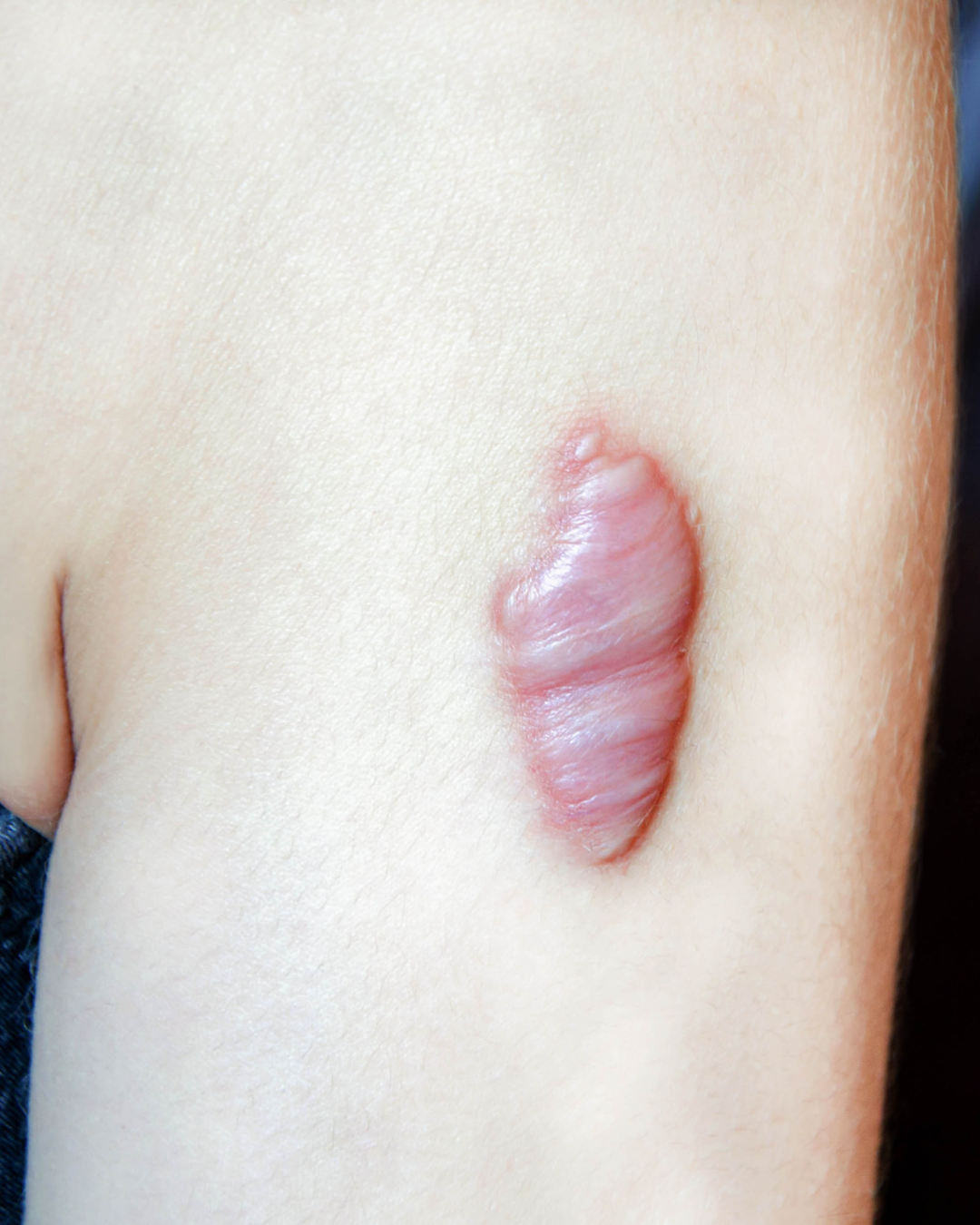 large keloid scar on arm