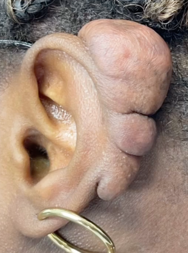 befoe image ear keloid