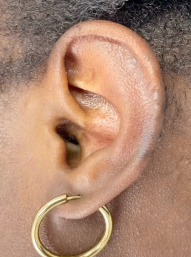 after image ear keloid