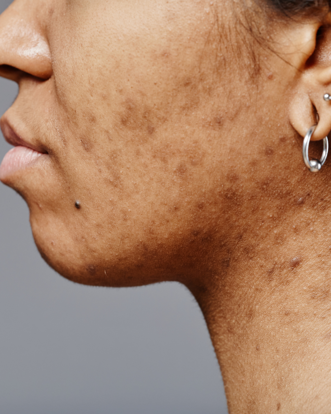 pigmentation from acne