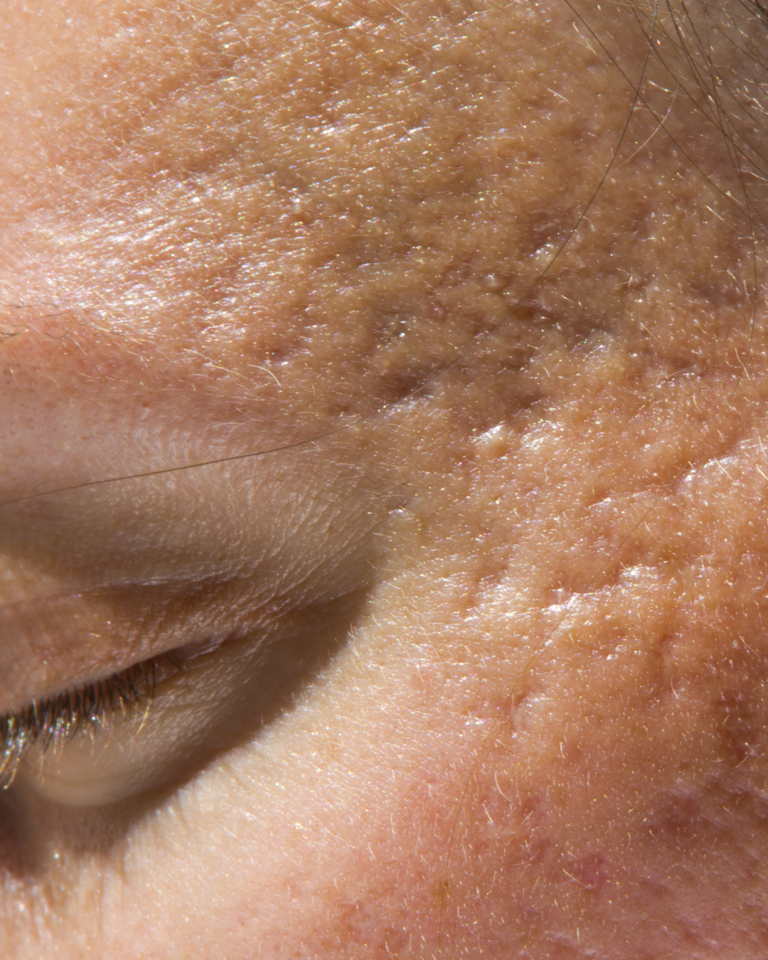 acne scars near eye