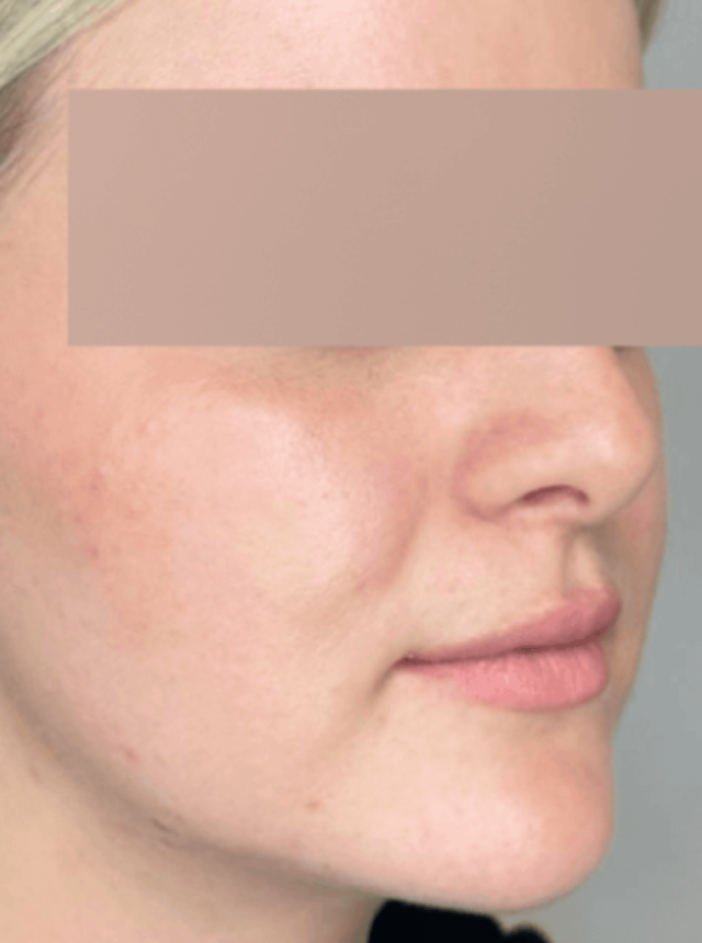 buccal fat reduction after