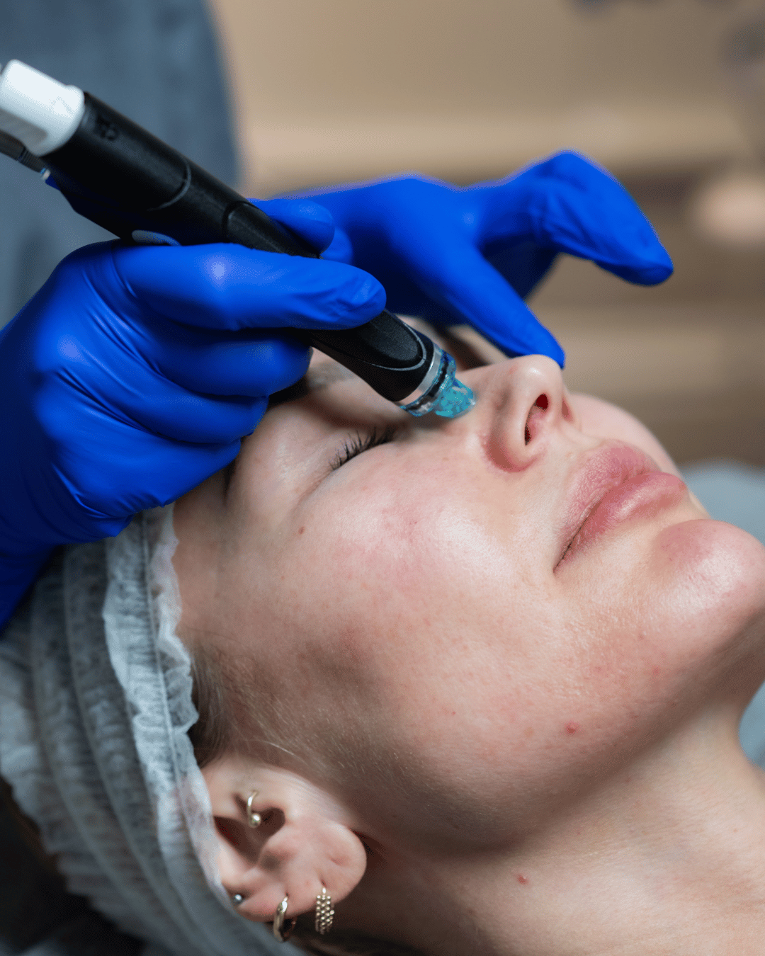 hydrafacial treatment nose unclogging