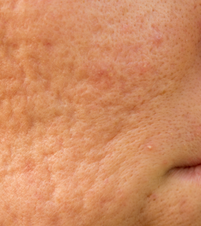 acne scars close up