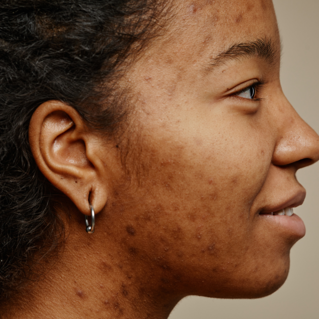 Hyperpigmentation Treatment