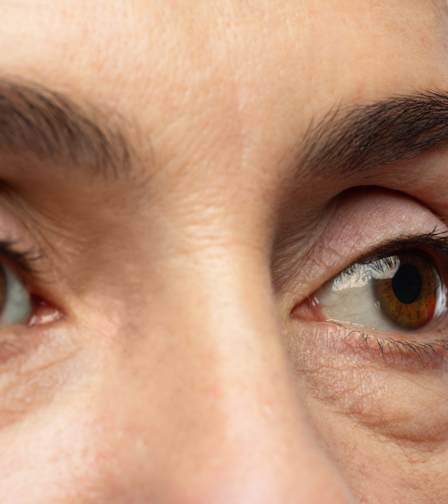 puffy eyes close up for blepharoplasty