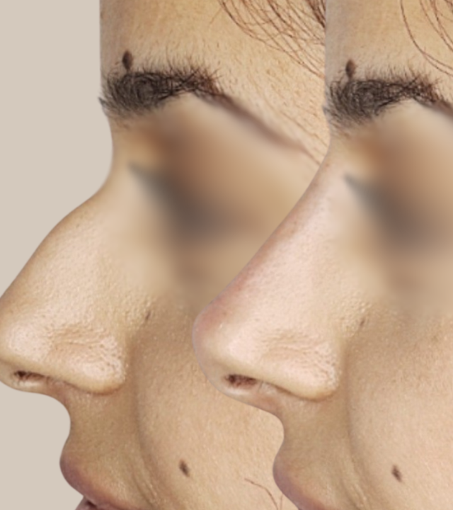 hump reduction in nose before and after