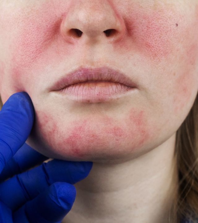 rosacea patient from the front