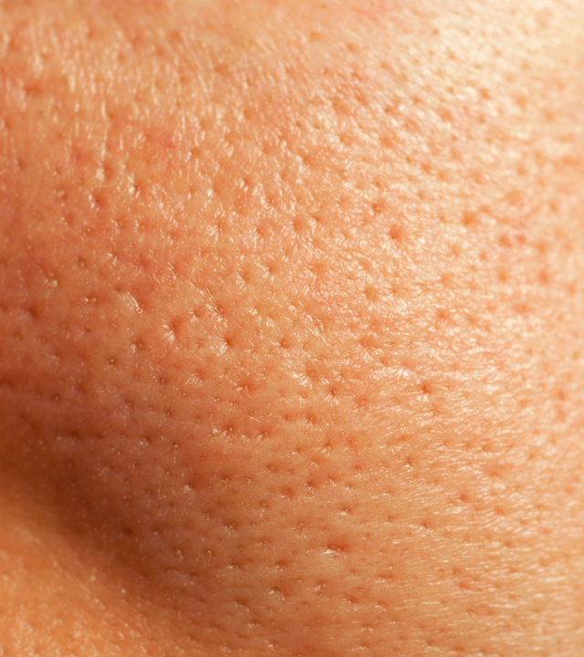 cheek pores enlarged