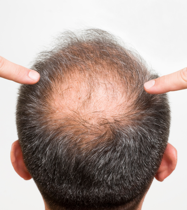 showing balding at the back of the head