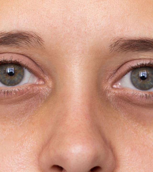 under eye cover image dark circles