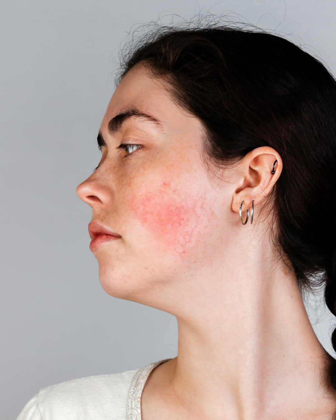 girl with rosacea on cheeks