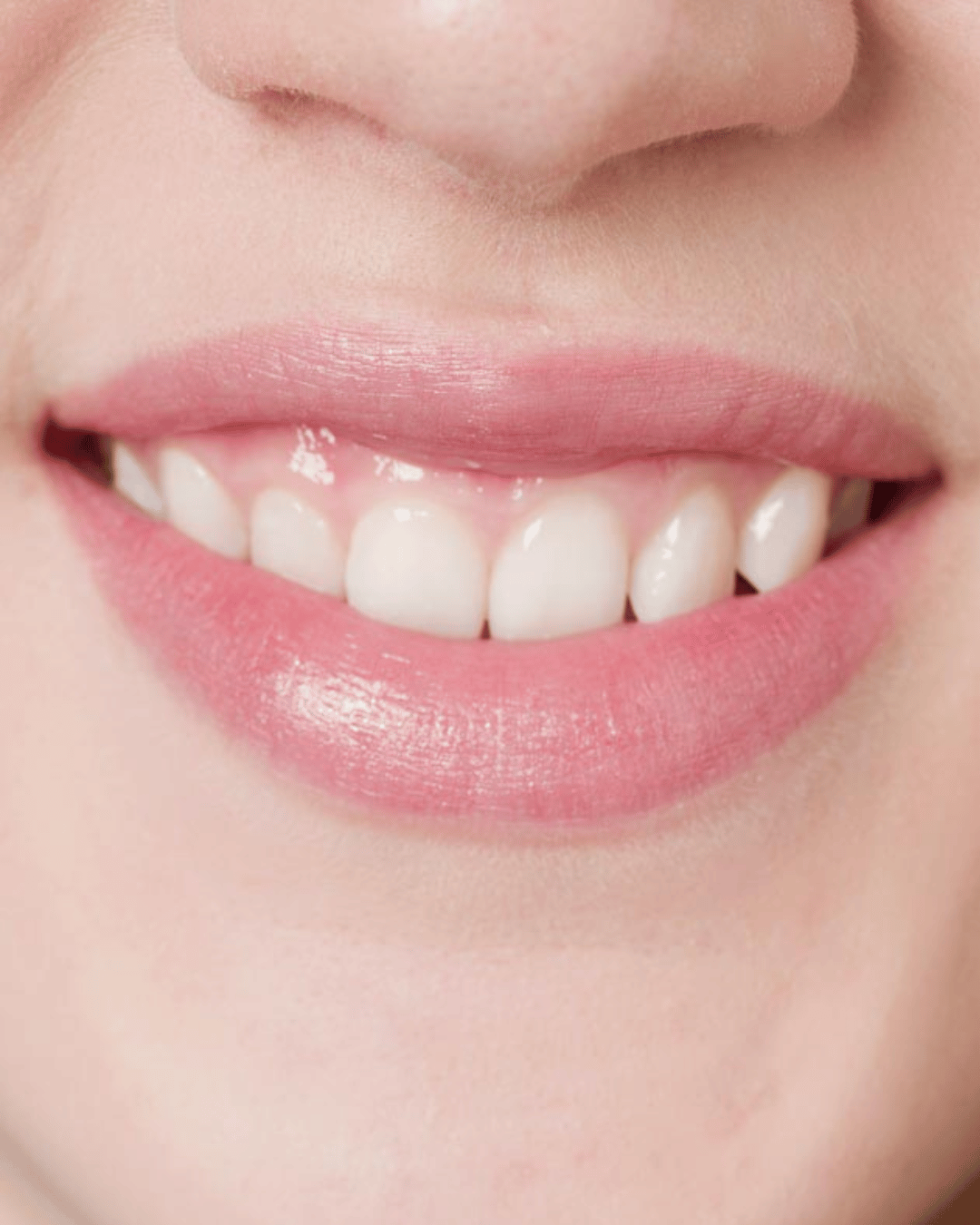 gummy smile close up