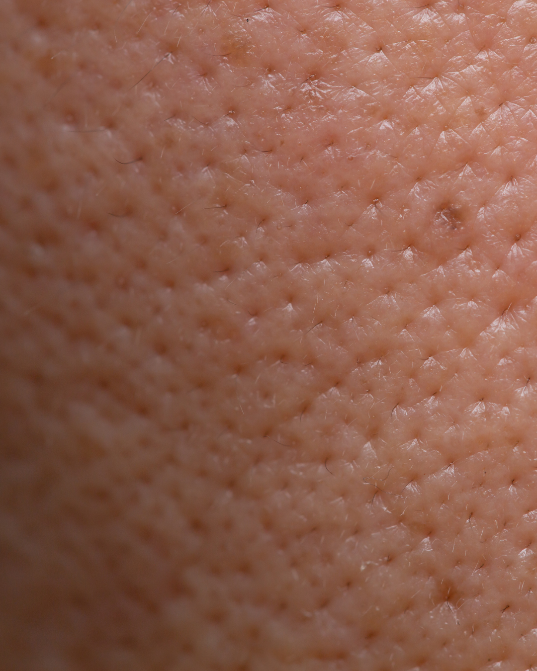 large pores on face