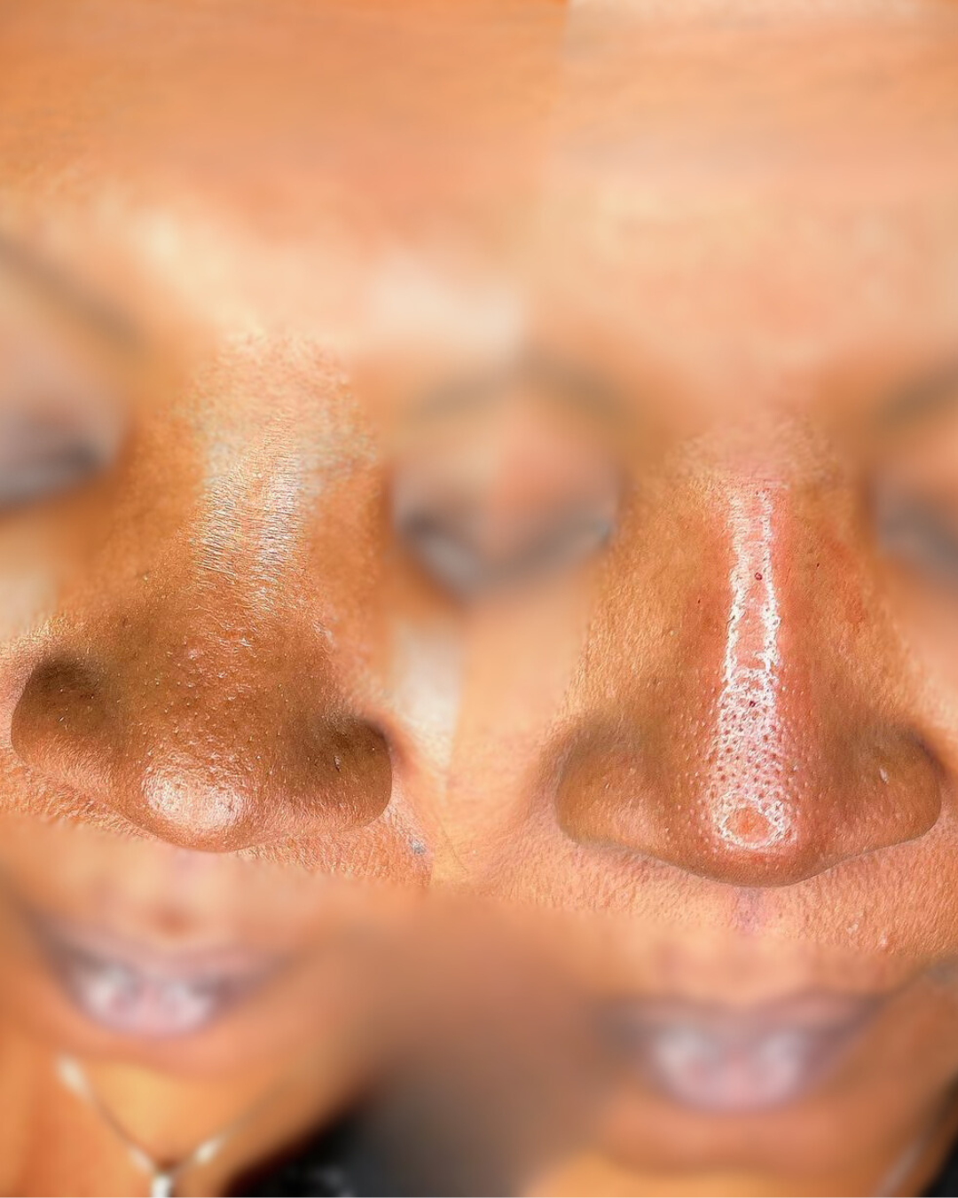 bulbous nose correction