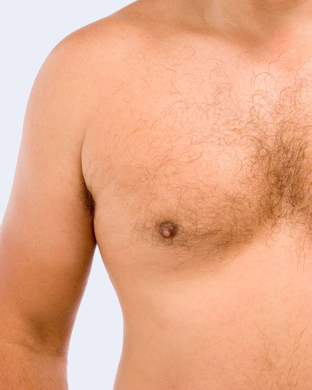 mens chest after Gynaecomastia