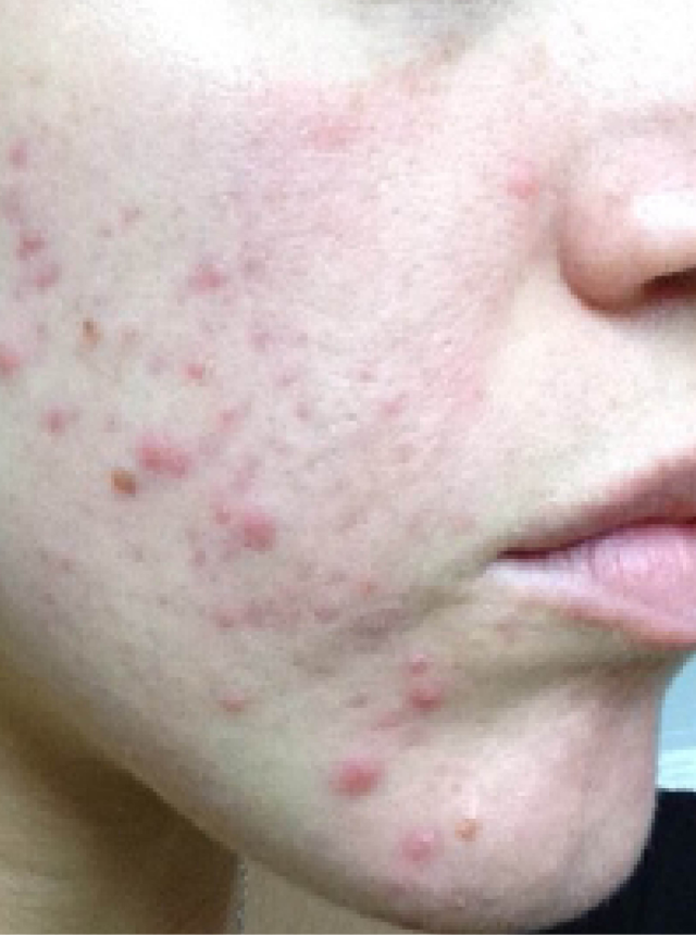 acne before illumifacial