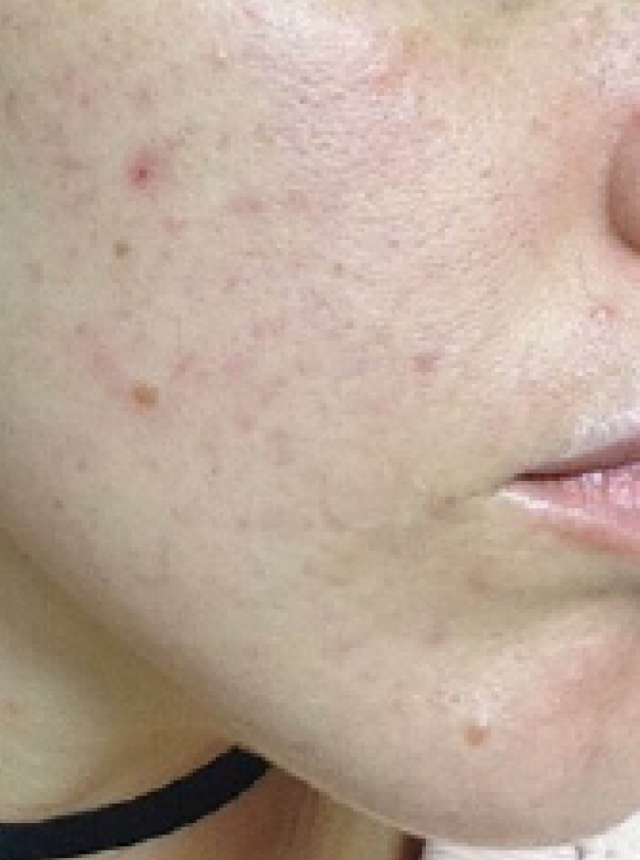 acne after illumifacial