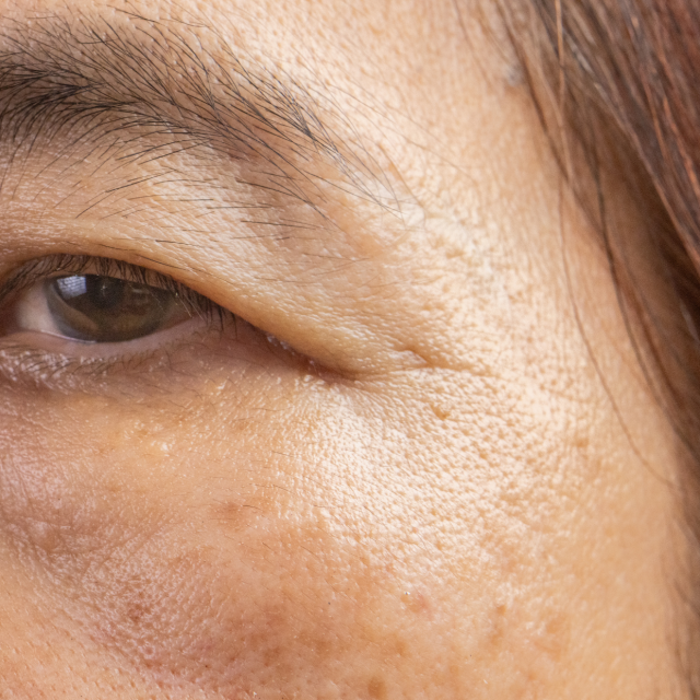 Asian Blepharoplasty