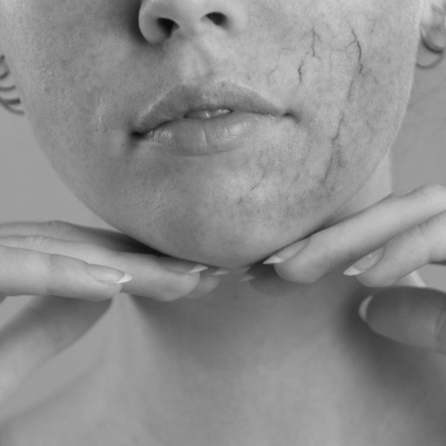 rosacea image mono