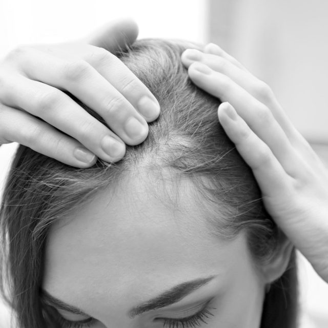 hair balding mono