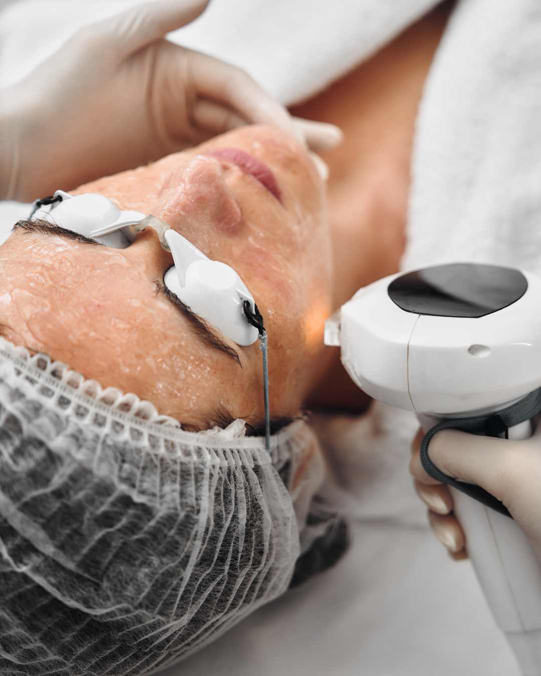 ipl facial treatment