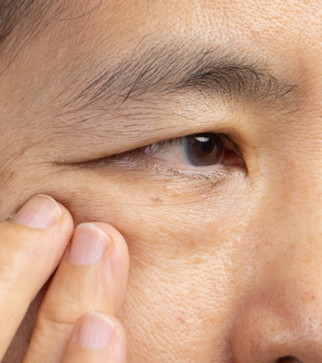 Asian Blepharoplasty for Natural Enhancement