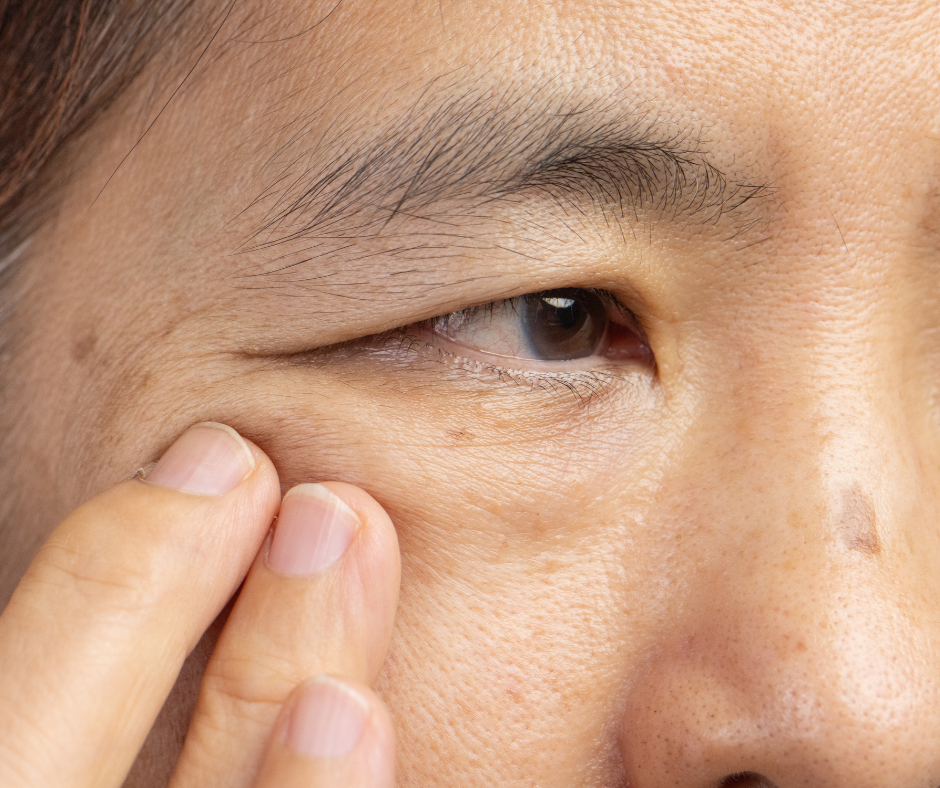 Asian Blepharoplasty for Natural Enhancement